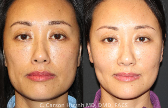 Fat Grafting Atlanta GA Radiance Surgery Aesthetic Medicine