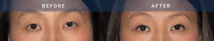 before and after asian eyelid surgery female patient surgery case 1974