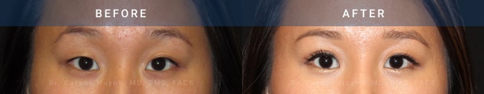 before and after asian eyelid surgery female patient surgery case 1983