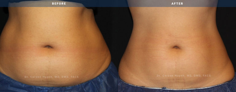 Before and after female abdomen coolsculpting front view