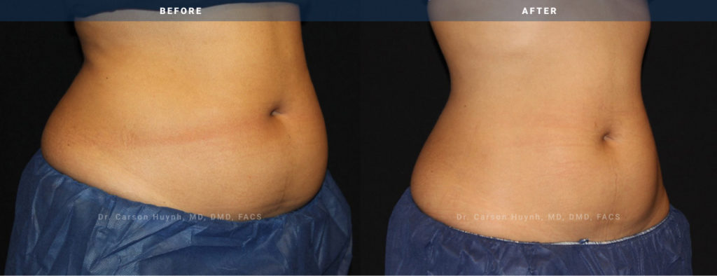 Before and after female abdomen coolsculpting left angle