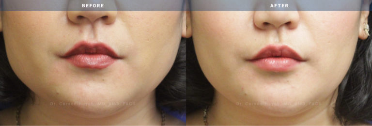 before and after buccal fat reduction view female patient surgery case 2011