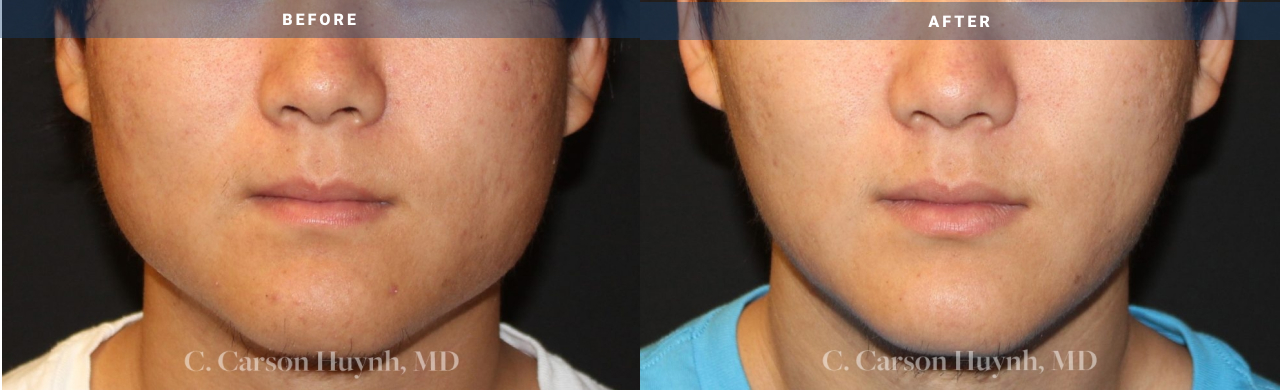 before and after buccal fat reduction view male patient surgery case 2013