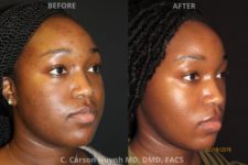 before and after buccal fat reduction right angle view surgery case 2039