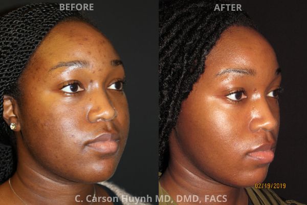 before and after buccal fat reduction right angle view surgery case 2039