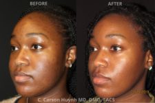 before and after buccal fat reduction angle view surgery case 2039