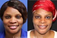 before and after chin augmentation front view surgery case 2043