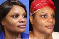 before and after chin augmentation angle view surgery case 2043