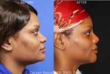 before and after chin augmentation side view surgery case 2043