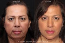 before and after chin augmentation front view surgery case 2047
