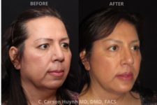 before and after chin augmentation angle view surgery case 2047