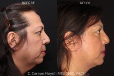 before and after chin augmentation side view surgery case 2047