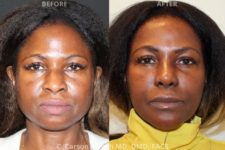 before and after chin augmentation front view surgery case 2051
