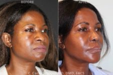 before and after chin augmentation angle view surgery case 2051