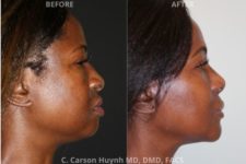 before and after chin augmentation side view surgery case 205