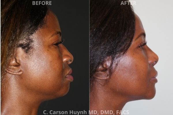 before and after chin augmentation side view surgery case 205