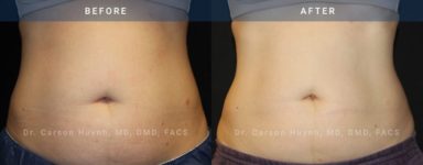 before and after coolsculpting front view case 2079