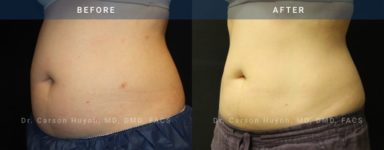 before and after coolsculpting left angle case 2079