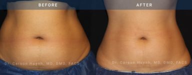 before and after coolsculpting front view case 2082