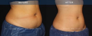 before and after coolsculpting right angle case 2085