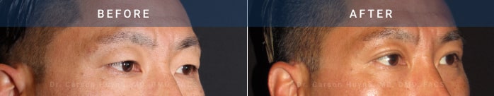 before and after eyelid surgery ptosis correction angle view case 1962