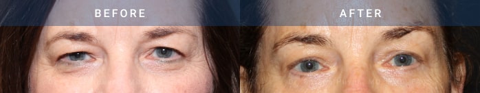 before and after eyelid surgery ptosis correction case 1968