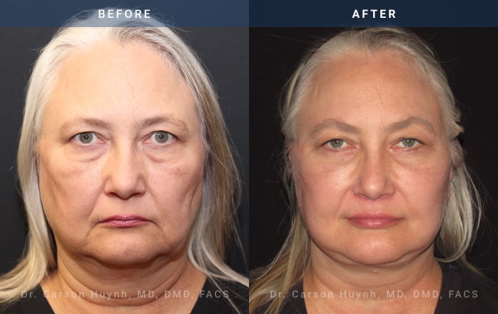 Before and After Facelift / Necklift front angle view Case 1915