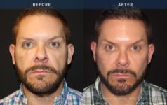 Before and After Facelift / Necklift Male patient front angle view Case 1927