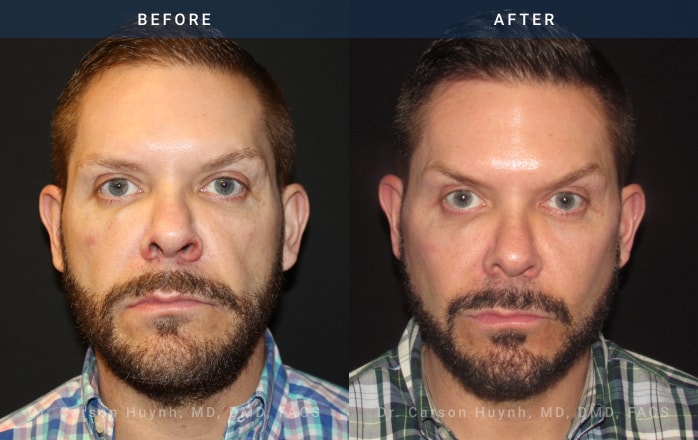 Before and After Facelift / Necklift Male patient front angle view Case 1927