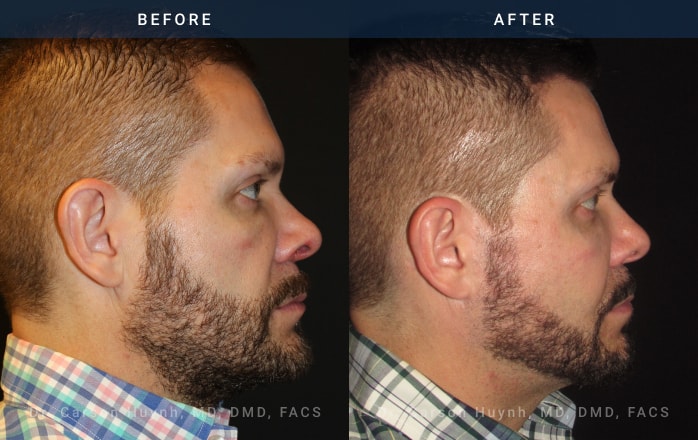 Before and After Facelift / Necklift Male patient side angle view Case 1927