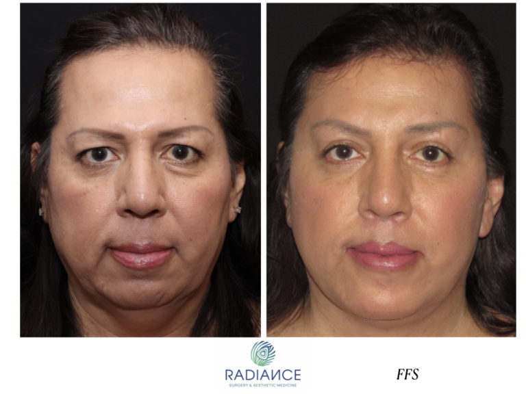 Before and After Facelift / Necklift female patient front view Case 1935