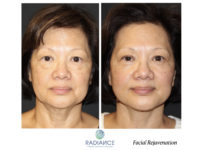 Before and After Facelift / Necklift female patient front angle view Case 1939