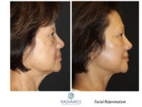 Before and After Facelift / Necklift female patient side angle view Case 1939