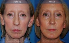 Before and After Facelift / Necklift female patient front angle view Case 1947