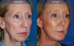 Before and After Facelift / Necklift female patient diagonal angle view Case 1947