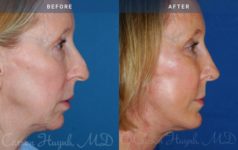 Before and After Facelift / Necklift female patient side angle view Case 1947