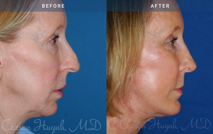 Before and After Facelift / Necklift female patient side angle view Case 1947