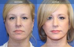 before and after neck lift front view case 1955