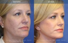 before and after neck lift angle view case 1955