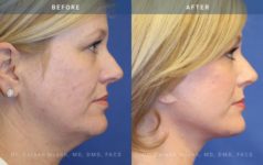 before and after neck lift side view case 1955