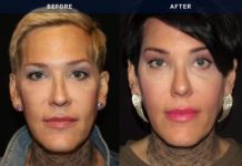 before and after female feminization front view case 2134
