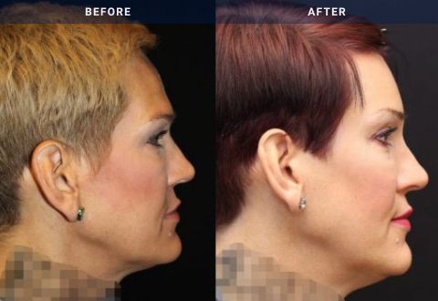 before and afterfemale feminization right side view case 2134