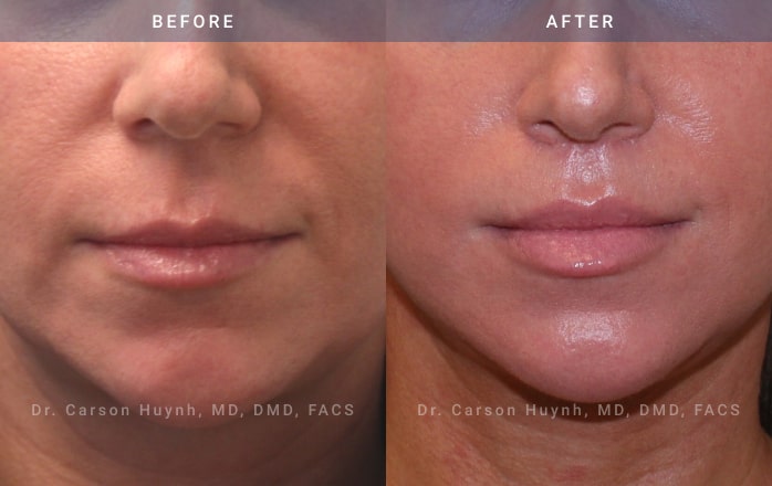 before and after lip lift | Radiance Atlanta, GA