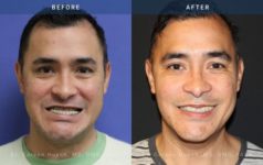 before and after orthognathic front view surgery case 2055