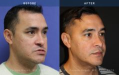 before and after orthognathic angle view surgery case 2055
