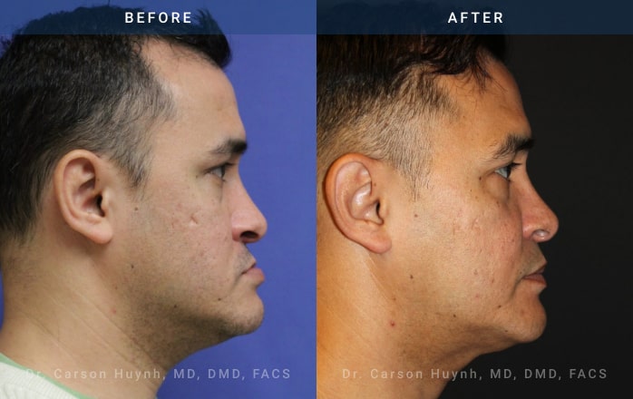 before and after orthognathic side view surgery case 2055