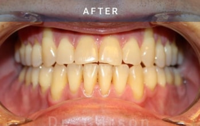 after orthognathic surgery case 2055