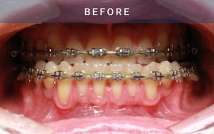 before orthognathic surgery case 2055