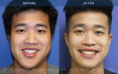 before and after orthognathic front view surgery case 2061