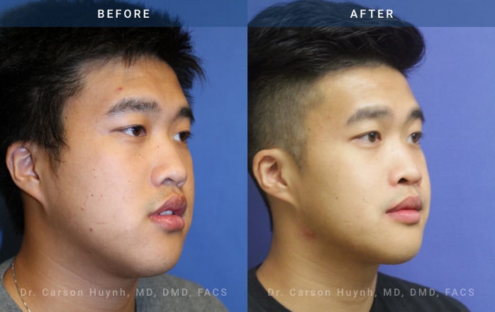 before and after orthognathic angle view surgery case 2061